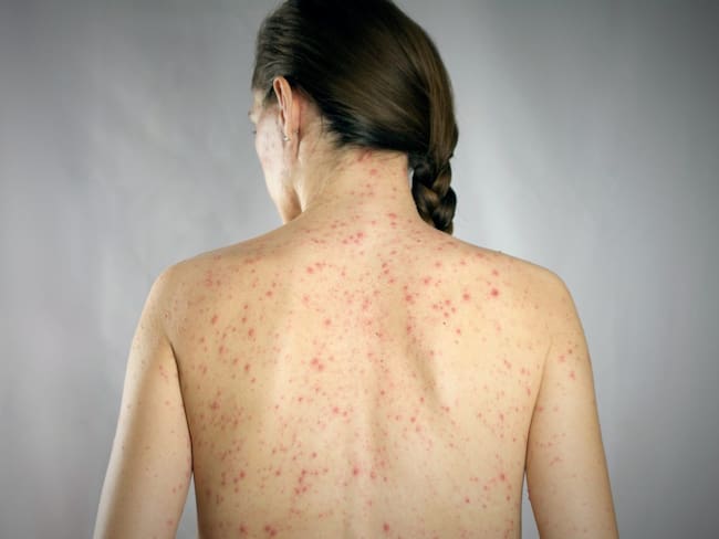 CDMX registra 113 casos de sarampión: Clara Brugada pide a menores de 49 años vacunarse