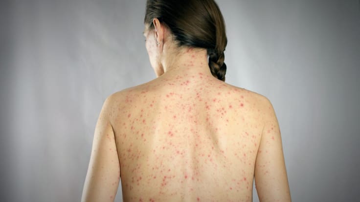 CDMX registra 113 casos de sarampión: Clara Brugada pide a menores de 49 años vacunarse