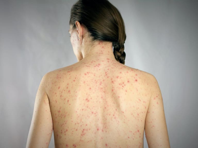 CDMX registra 113 casos de sarampión: Clara Brugada pide a menores de 49 años vacunarse