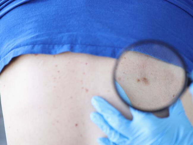 ¡Evita el cáncer de piel! Un cuidado preventivo es la clave