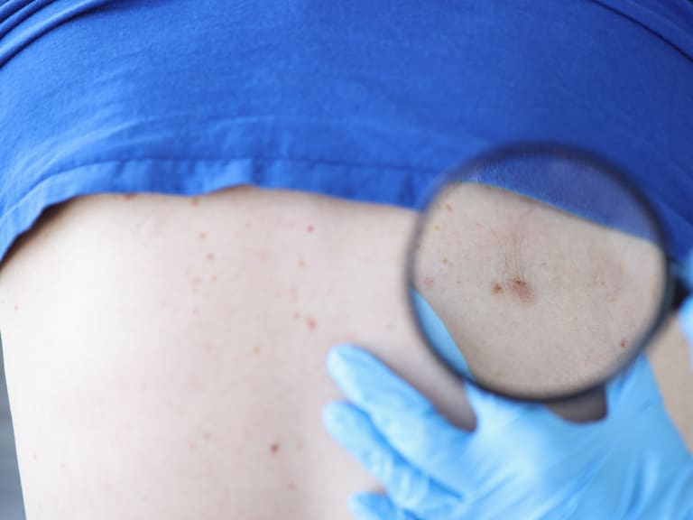 ¡Evita el cáncer de piel! Un cuidado preventivo es la clave
