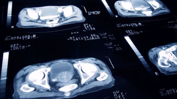 10 mitos y verdades sobre el cáncer de próstata