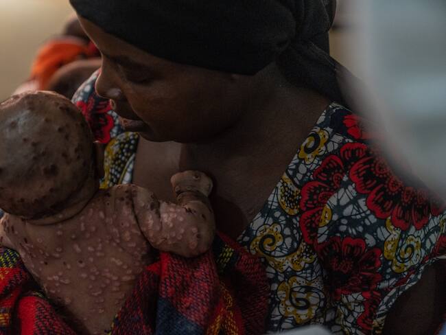 Aumentan 89% los casos  de Mpox en Europa: OMS