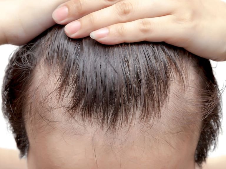 ¿Qué onda con los tipos de alopecia?