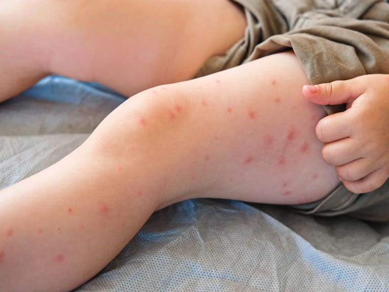 (6 de marzo de 2026) Aumentan los contagios de sarampión en México. En las últimas 24 horas se registraron 124 nuevos contagios, informó la Secretaría de Salud.