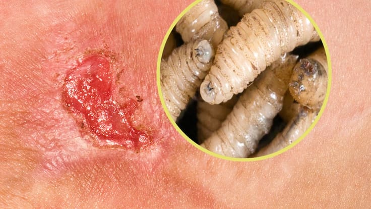 Gusano Barrenador: ¿Cuál es el tratamiento para combatirlo en humanos?