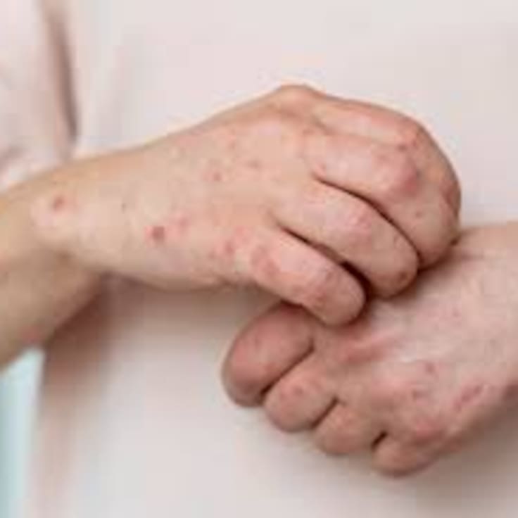 México supera los 10 mil contagios de sarampión; suman 31 muertes