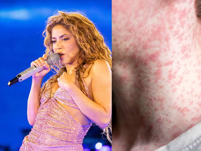 ¿Fuiste al concierto de Shakira? Alertan por posible exposición a sarampión en Nueva Jersey