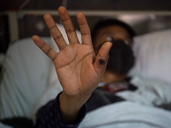 Se confirman 6 nuevos casos de viruela de mono