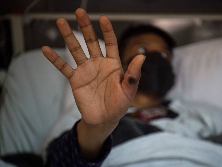 Paciente con lesiones provocadas por mpox.