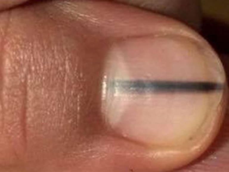 Manicurista descubre melanoma en la uña de una clienta