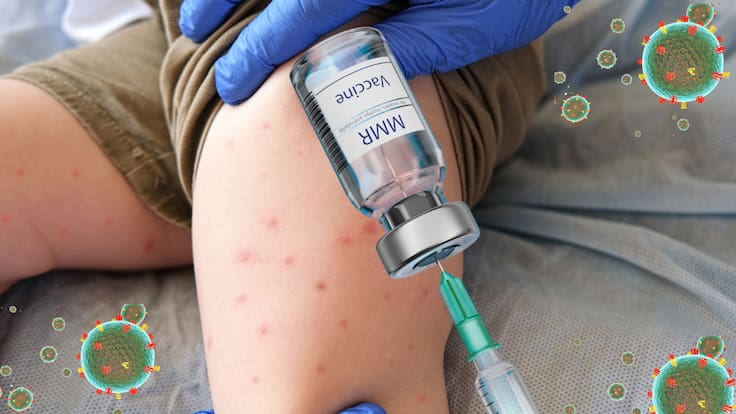 Vacuna contra el Sarampión en CDMX: ¿En dónde están vacunando HOY?; Módulos y horarios