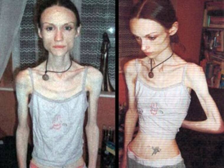 Lipofobia. Mercedes Altamirano, corresponsal. 06/03/13