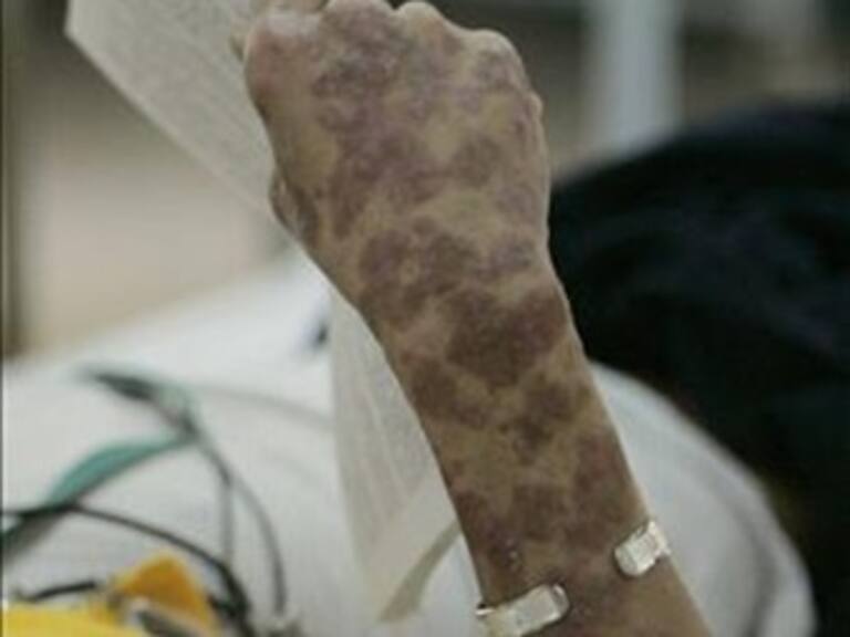 Reportan 10 mil 436 infectados con Sida en Paraguay