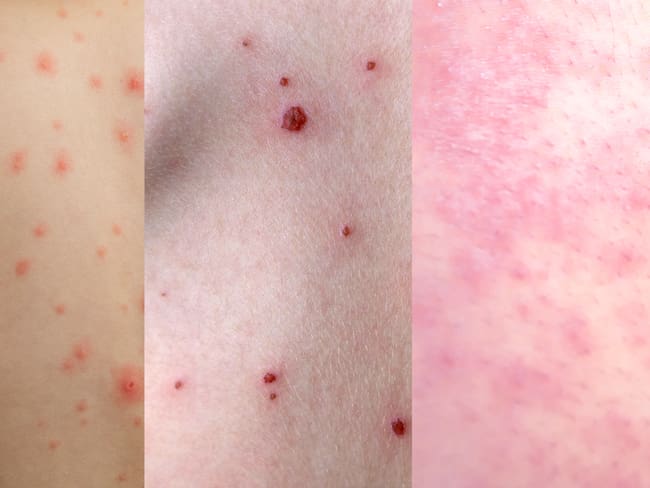 Diferencias entre sarampión, varicela y viruela: causas, síntomas y características clave