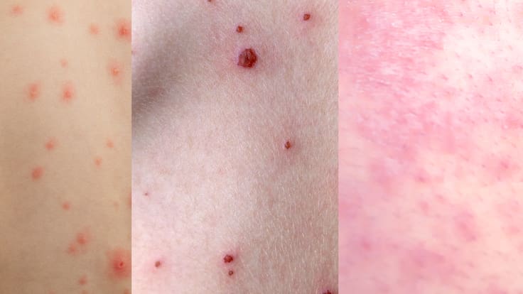 Diferencias entre sarampión, varicela y viruela: causas, síntomas y características clave