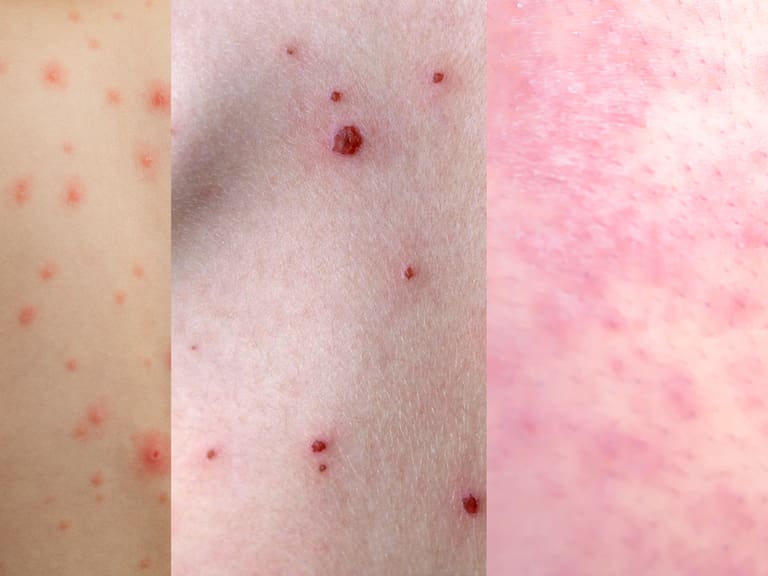 Sarampión, varicela, viruela