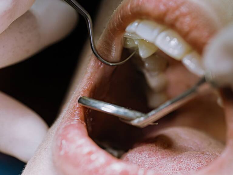 45% de la población adulta del mundo ha visitado al dentista por una endodoncista