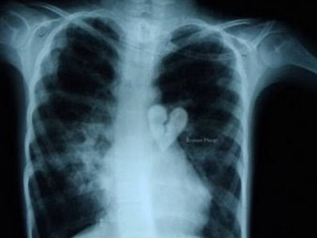 ¿Sabías que existe el síndrome del corazón roto?