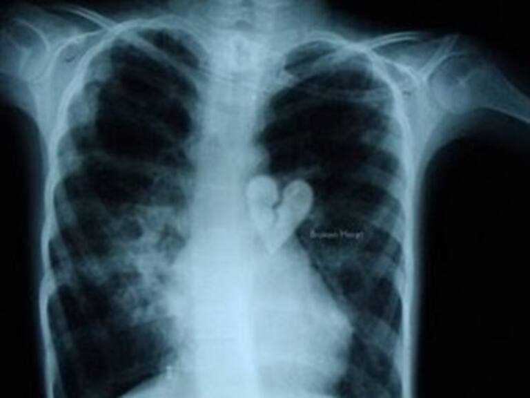 ¿Sabías que existe el síndrome del corazón roto?