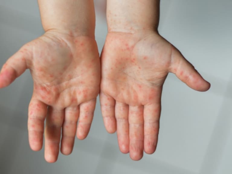 La Ciudad de México se ubica en el cuarto lugar con más casos acumulados de esta enfermedad