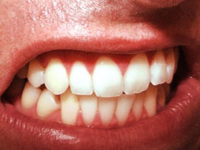 ¿Bruxismo?, descubre qué es con Joan Cerezo en 'La Valla Informativa'