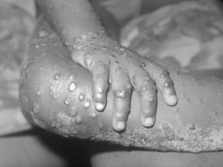 La gripe del tomate tiene síntomas parecidos al COVID y a la viruela del mono.