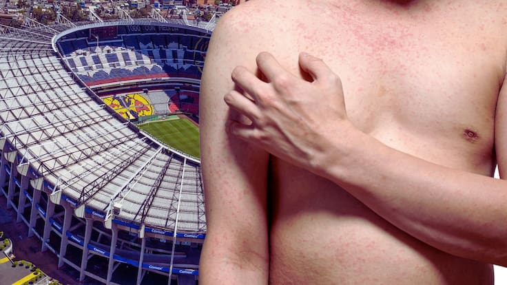 Sarampión en México: ¿Se puede cancelar el Mundial 2026 por aumento de contagios?