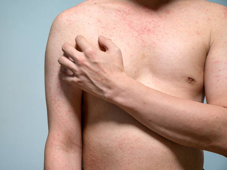 Lanza Secretaría de Salud aviso preventivo por sarampión a quienes viajen a EEUU y Canadá