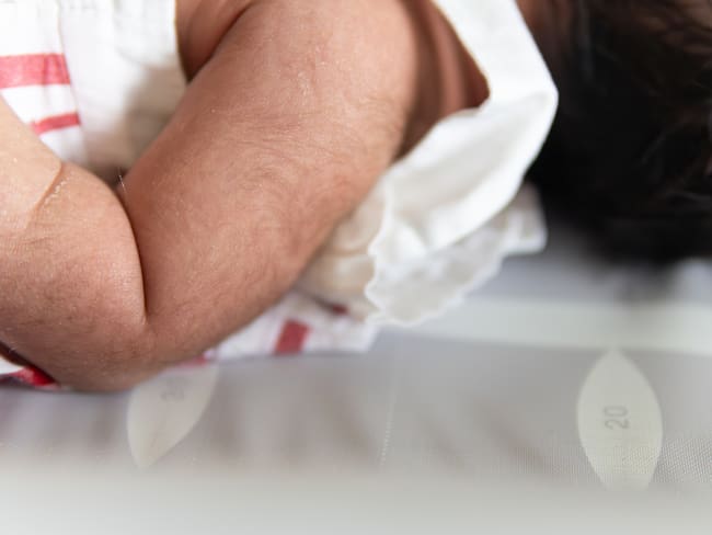 Minoxidil: Otros efectos del fármaco que causó síndrome del hombre lobo en bebés