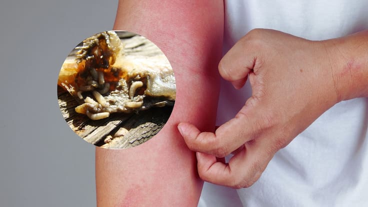 Alerta en San Luis Potosí: Detectan casos de gusano barrenador en mujeres adultas