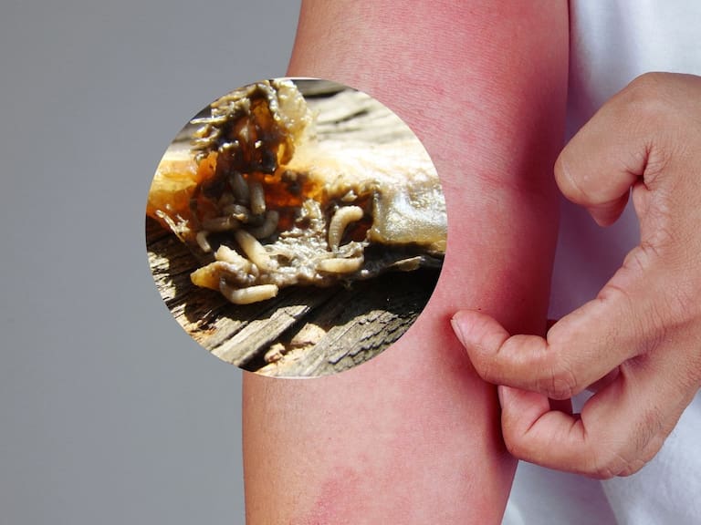 Qué es la miasis y cómo evitar el gusano barrenador. Getty Images