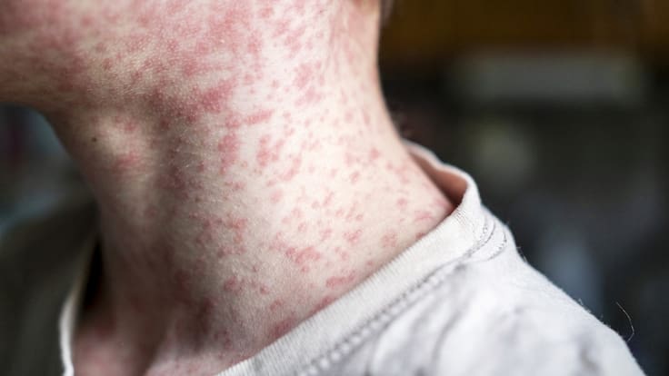 CDMX reporta primera muerte por sarampión; suman 28 decesos en el país