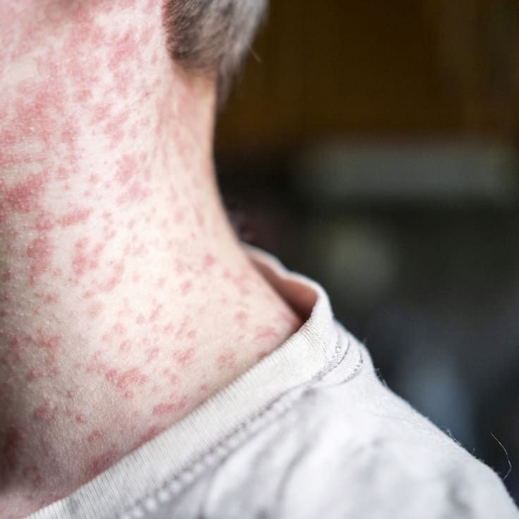 CDMX reporta primera muerte por sarampión; suman 28 decesos en el país