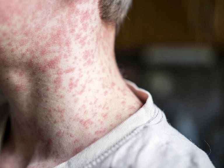 CDMX reporta primera muerte por sarampión