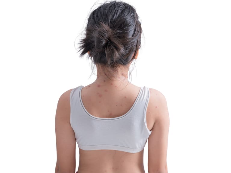 A young girl shows her back with chickenpox scars on her body, isolated on a white background.