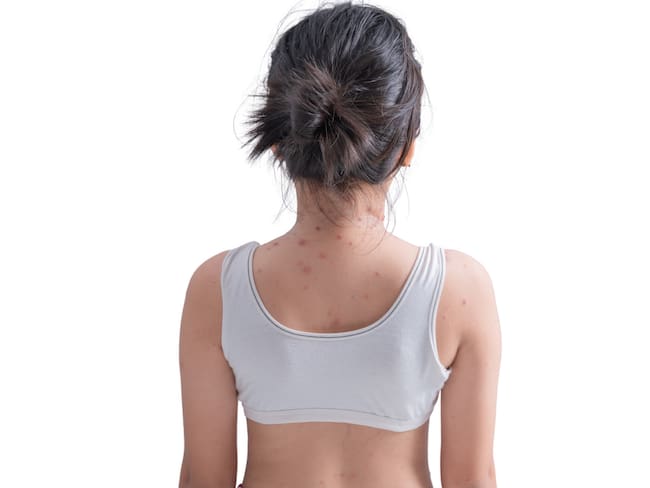 Brote de sarampión deja 36 fallecidos en México; Jalisco confirma una nueva muerte