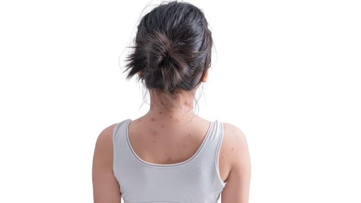 Brote de sarampión deja 36 fallecidos en México; Jalisco confirma una nueva muerte