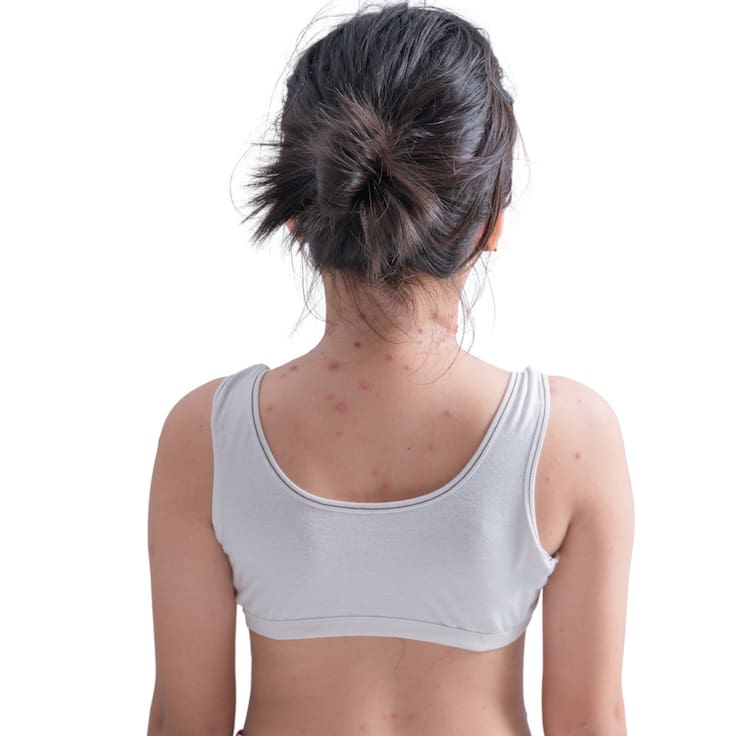 Brote de sarampión deja 36 fallecidos en México; Jalisco confirma una nueva muerte