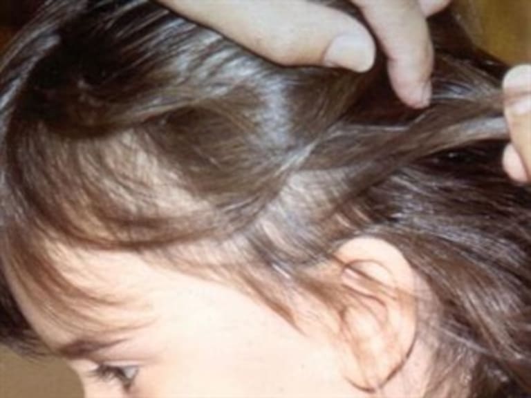 Conoce la pediculosis, mejor conocida como ‘Piojos’