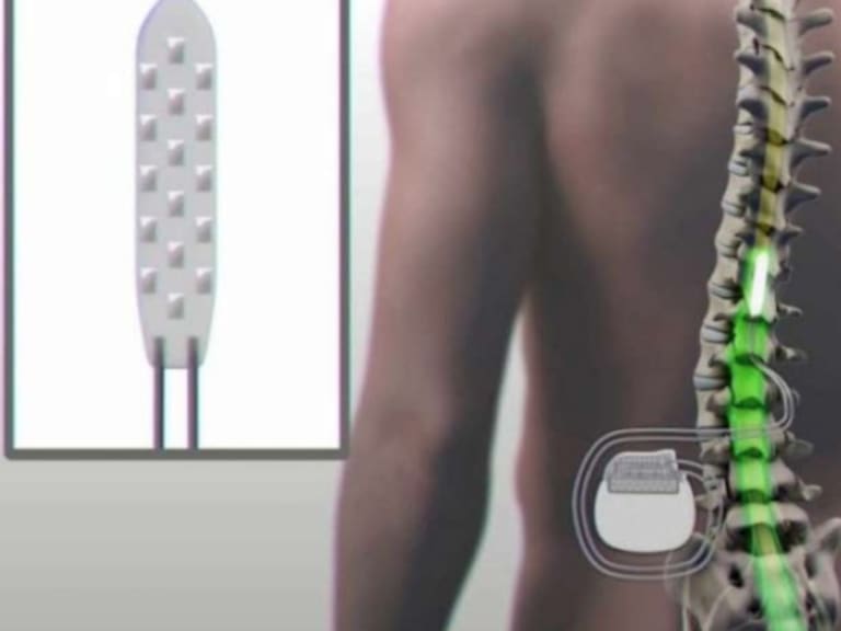 Nuevo dispositivo implantado en la médula permite caminar a paciente con parálisis