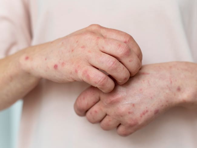 Brote de sarampión en México: Secretaría de Salud confirma 7 mil 168 casos y 24 muertes por falta de vacunación