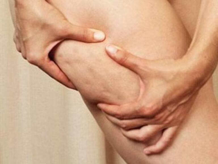 Checa esta dieta anticelulitis