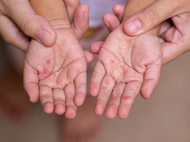 ¿Qué es la ‘gripe del tomate’ y por qué el virus coxsackie solo afecta a menores de 5 años?