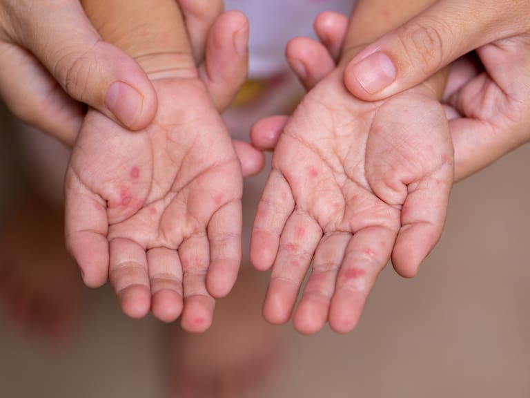 Se le conoce como "Gripa del tomate" a un virus llamado coxsackie.