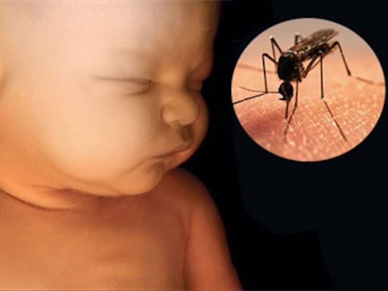 Alerta de microcefalia en Brasil por virus del zika