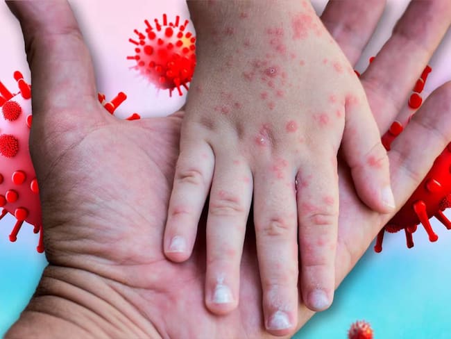 Brote de sarampión en México: Suman 17 mil contagios y 40 muertes; los niños son los más afectados