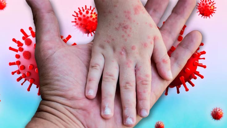 Brote de sarampión en México: Suman 17 mil contagios y 40 muertes; los niños son los más afectados