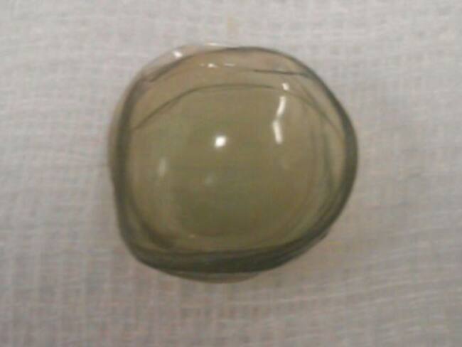 Encuentran 27 lentes de contacto en el ojo de una paciente de 67 años