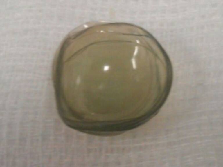 Encuentran 27 lentes de contacto en el ojo de una paciente de 67 años